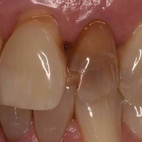 naprawa zębów